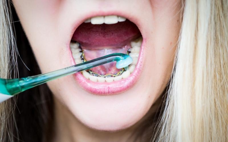 Nẹp răng mặt trong tốt không
