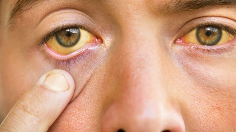 Gan nhiễm mỡ có triệu chứng gì ở giai đoạn nặng?