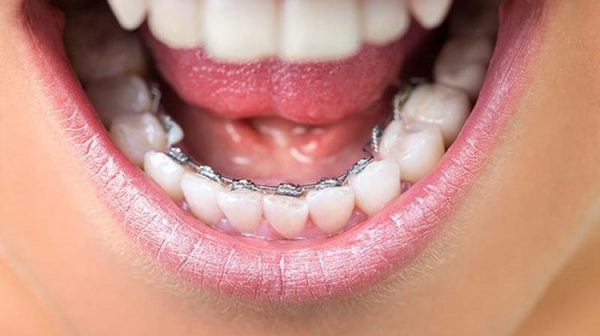 Niểng răng mặt trong có tính thẩm mỹ cao 