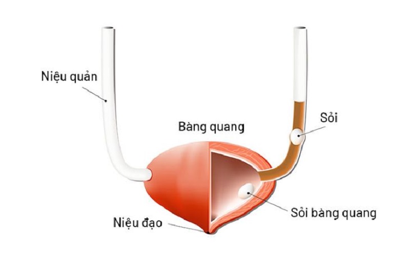 nội soi bàng quang