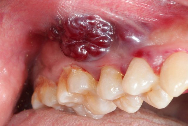 Ung thư khoang miệng đang là nhóm bệnh lý có xu hướng gia tăng hiện nay