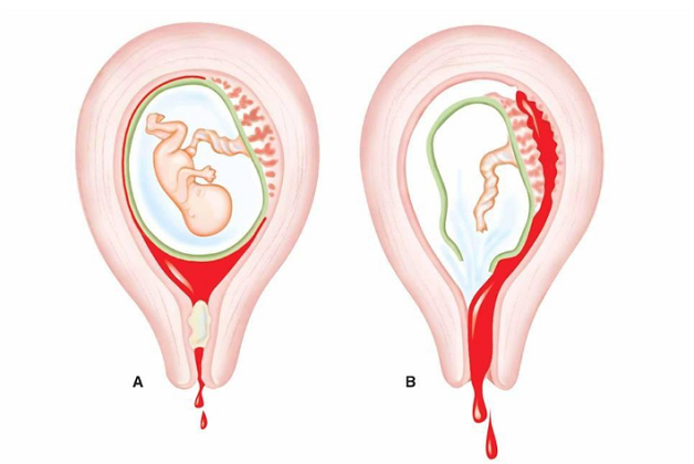 Vỡ tử cung là một trong những tai biến sản khoa vô cùng nguy hiểm