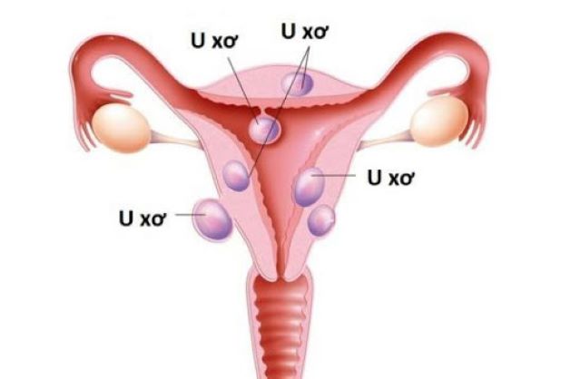 U xơ tử cung hay còn có tên gọi khác là nhân xơ tử cung và thường xuất hiện ở cơ trơn của tử cung.