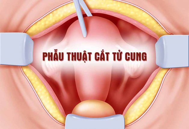 Phẫu thuật cắt tử cung là phương pháp khá phổ biến trong lĩnh vực sản khoa