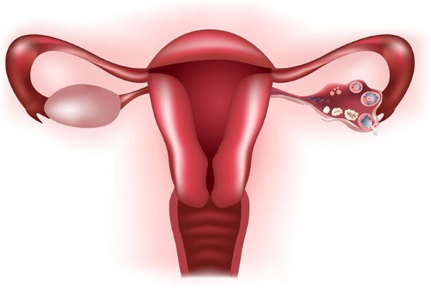 Tắc vòi trứng sẽ là tình trạng ống dẫn trứng bị teo hẹp, chít nhỏ lại và làm ngăn cản sự di chuyển của tinh trùng và noãn gặp nhau và gây ảnh hưởng tới khả năng sinh sản