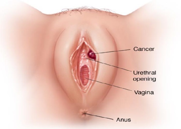 Polyp âm đạo là căn bệnh nhiều chị em phụ nữ gặp phải