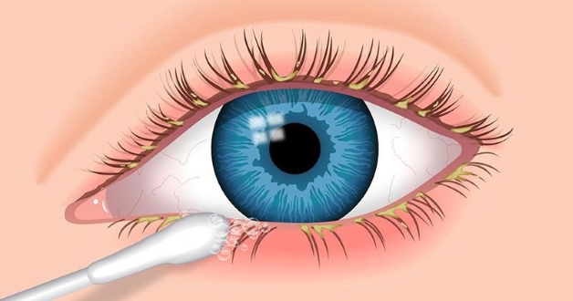 Viêm bờ mi là một trong những nguyên nhân dẫn đến quặm mí mắt