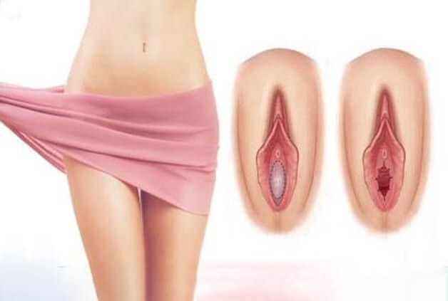 Rách âm đạo là tình trạng thường gặp của chị em phụ nữ khi sinh thường