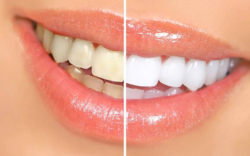 Tẩy trắng răng đắt không?