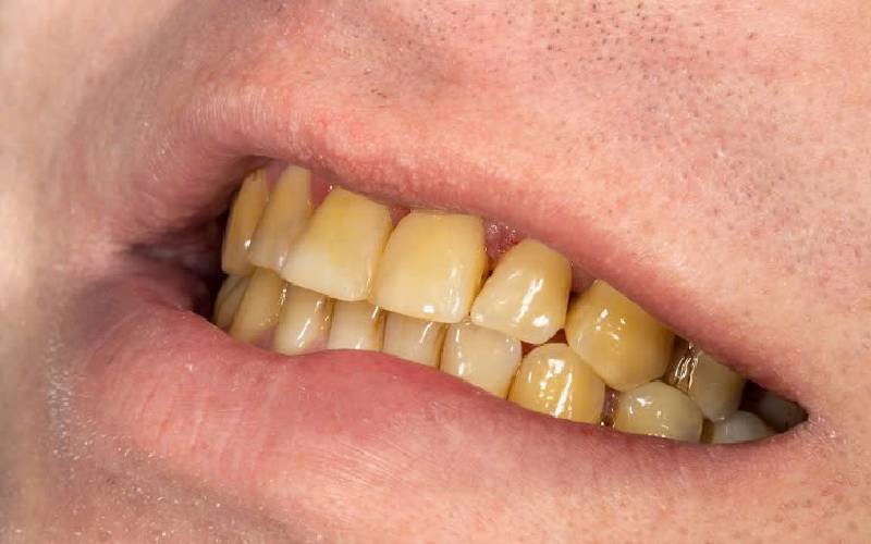 Tẩy trắng răng bằng cách nào