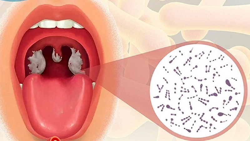 Nên tiêm mũi phòng bệnh bạch hầu nhắc lại để tăng cường bảo vệ