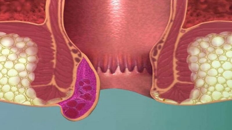 Trĩ nội sa ra ngoài thường xảy ra ở giai đoạn tiến triển của bệnh