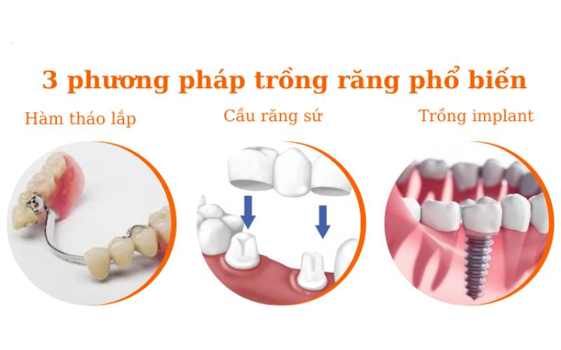 Trồng răng giả bao nhiêu tiền