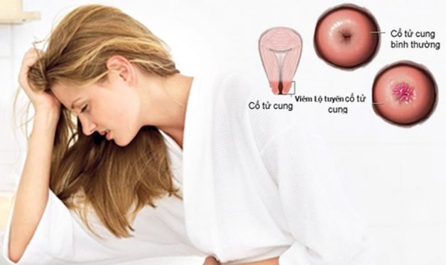 Có nhiều nguyên nhân dẫn tới bệnh lộ tuyến cổ tử cung