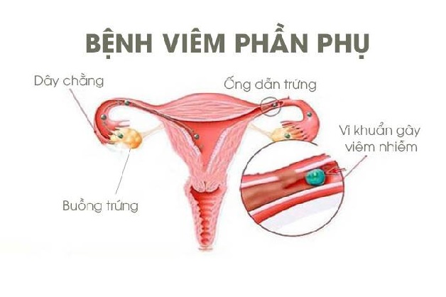 Viêm phần phụ là bệnh nhiều chị em gặp phải
