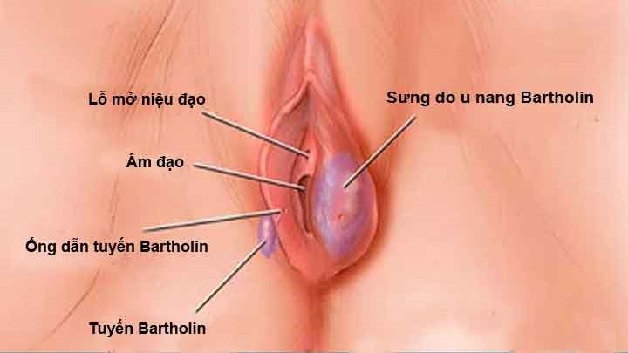 Viêm tuyến Bartholin xảy ra ở phụ nữ trong độ tuổi sinh sản