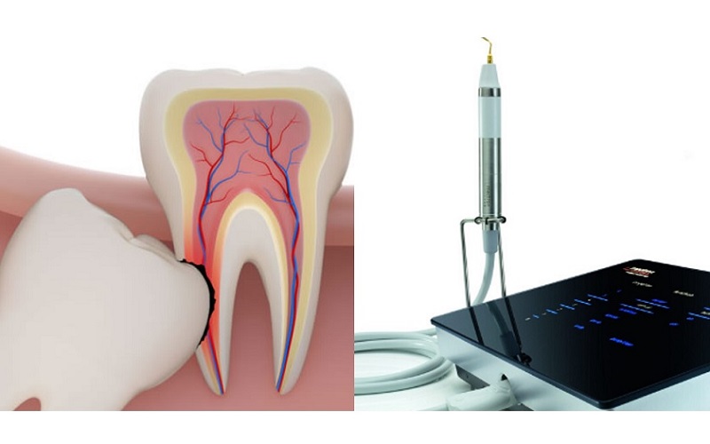 Nhổ răng số 8 bằng máy siêu âm Piezotome