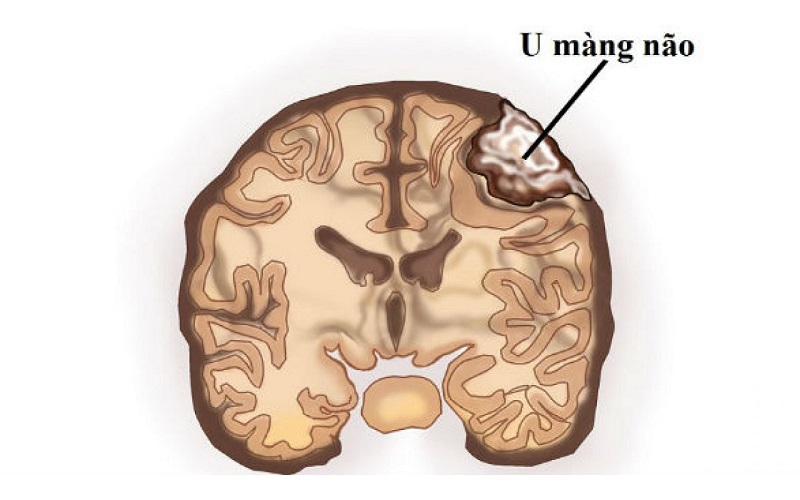 u màng não