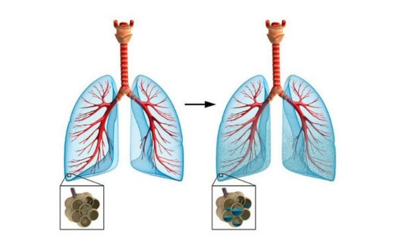 chẩn đoán hình ảnh phù phổi cấp 