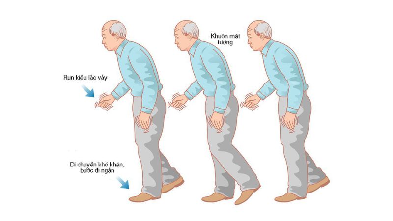 Chẩn đoán bệnh Parkinson thông qua các triệu chứng lâm sàng