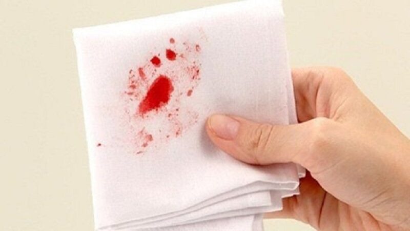 Bệnh trĩ ra nhiều máu - khi phân khô cứng và phải dùng sức rặn mạnh, búi trĩ dễ bị ma sát, vỡ ra, dẫn đến chảy máu