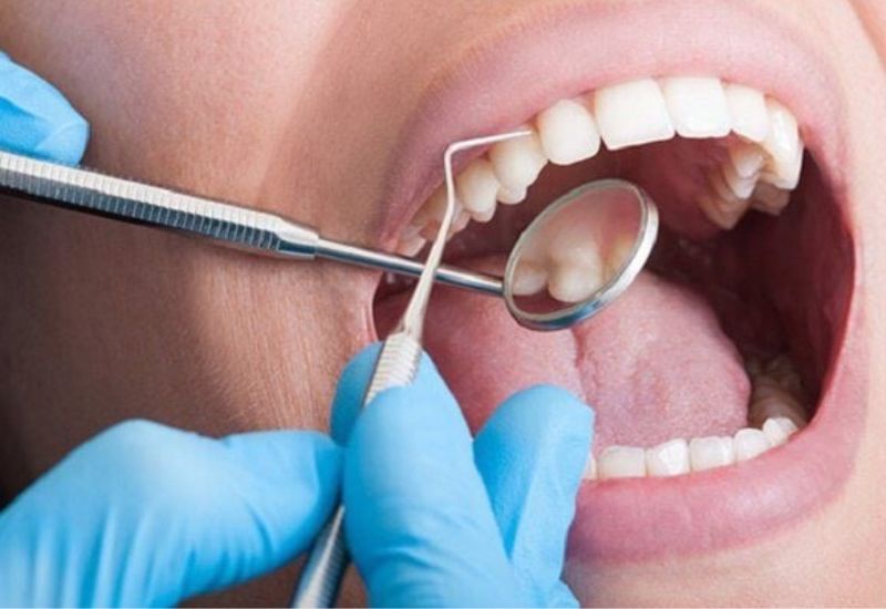 Hãy lấy cao răng định kỳ để duy trì sức khỏe răng miệng tốt nhất.