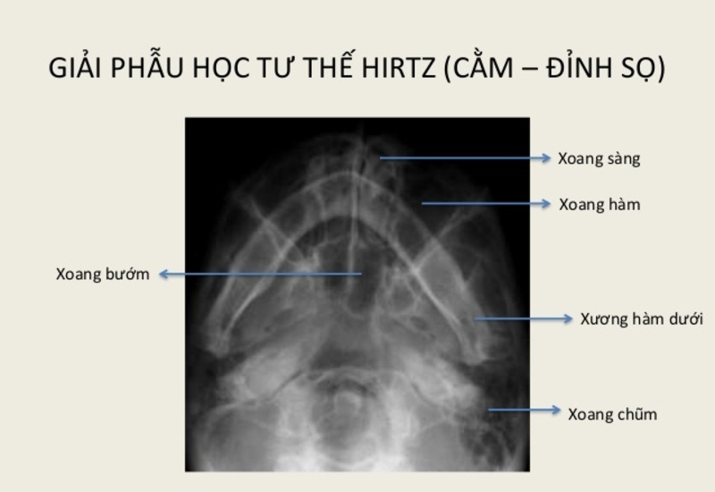 Chụp X-quang viêm xoang tư thế Hirtz