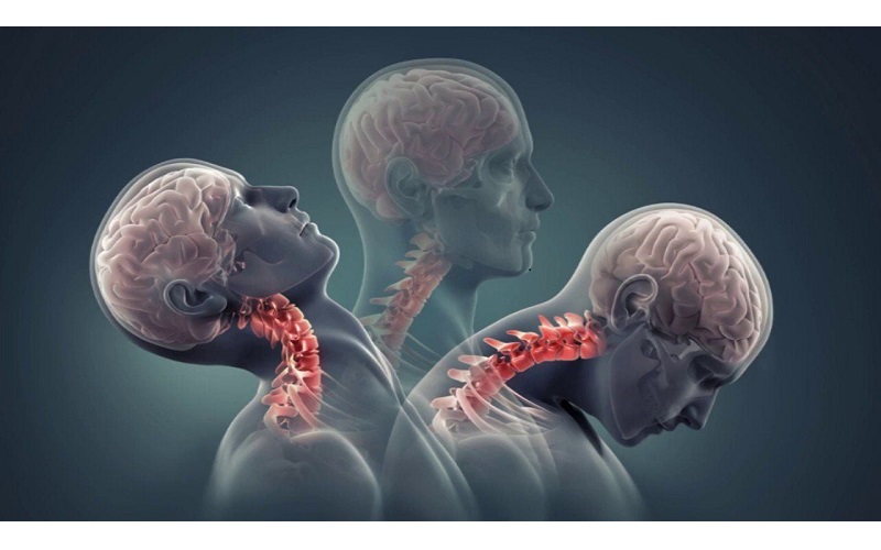 Bệnh lý về cổ được phát hiện thông qua kỹ thuật MRI