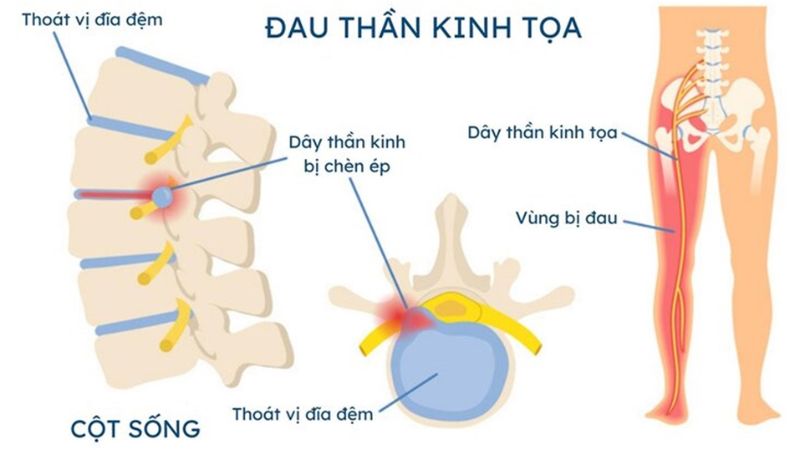 Tình trạng đau dây thần kinh tọa là gì?