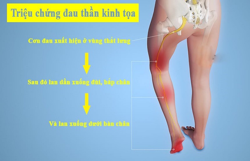 Đau dây thần kinh tọa là gì và nguyên nhân gây bệnh