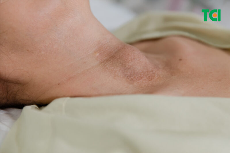 Vai trò của kỹ thuật RFA trong phẫu thuật điều trị u tuyến giáp lành tính