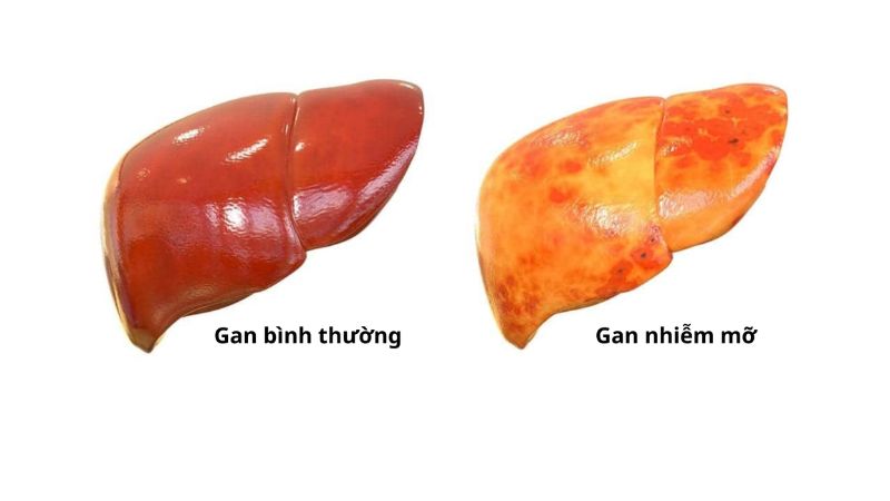 Gan nhiễm mỡ cấp độ 2 là bệnh gì?