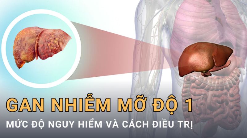 Gan nhiễm mỡ độ 1 là gì, có biểu hiện triệu chứng không?