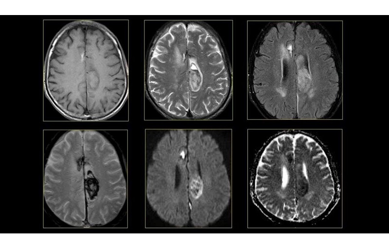 chụp MRI sọ não