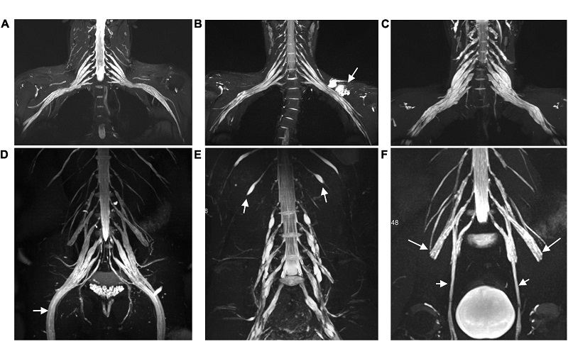 chụp MRI cột sống cổ