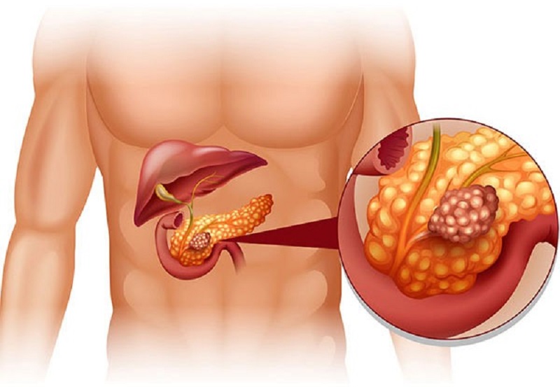 chẩn đoán hình ảnh viêm tụy mạn