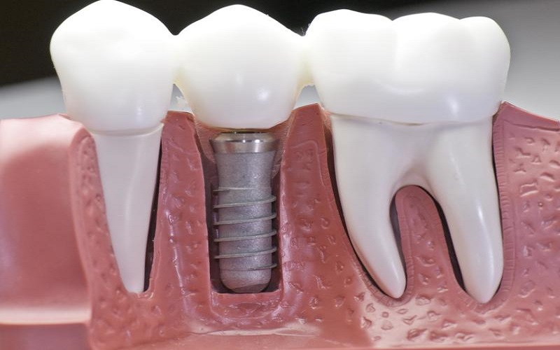 Răng giả có chụp MRI được không