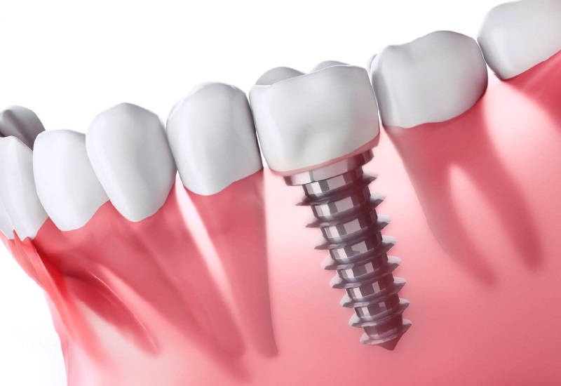 Răng giả được chế tác từ các hợp kim kim loại