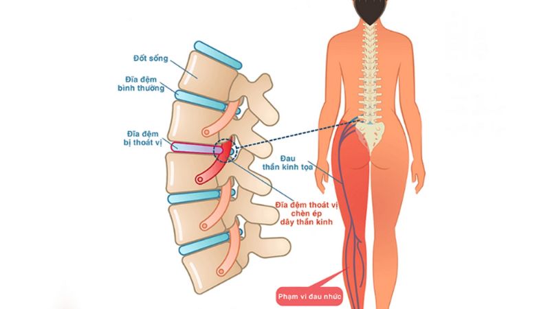 Đau dây thần kinh tọa nguyên nhân do đâu?