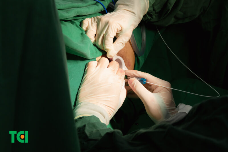 Quá trình đốt trĩ Laser Diode