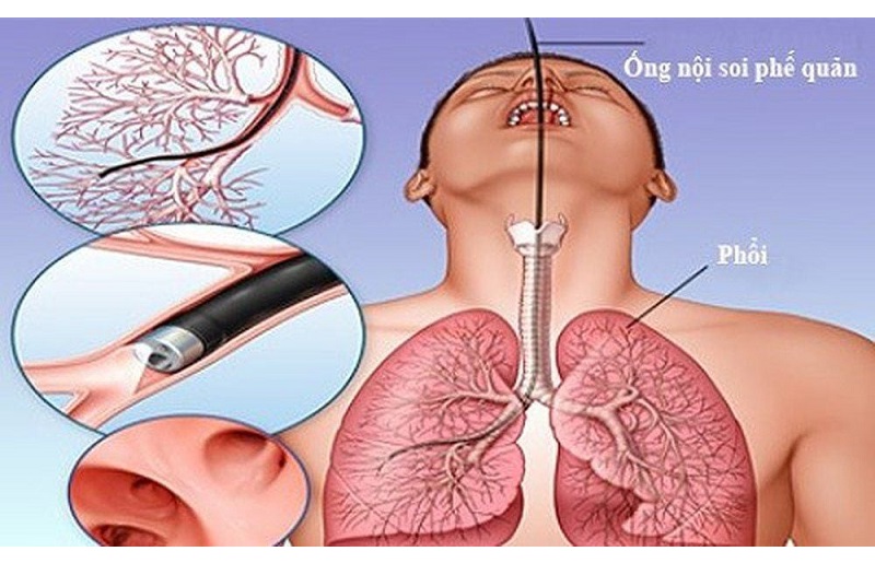nội soi phế quản là gì