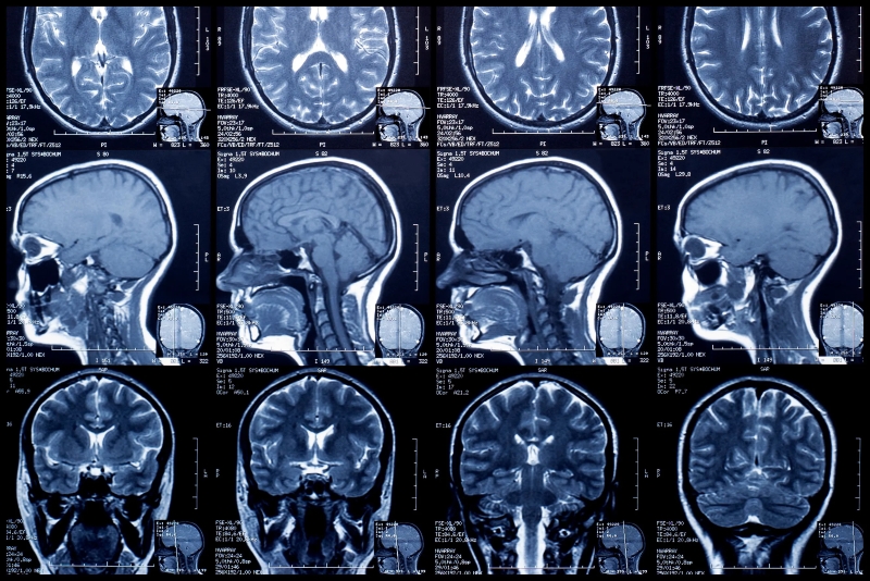 hình ảnh chụp MRI phát hiện bệnh về não