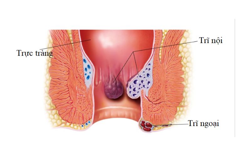 trĩ nội là gì