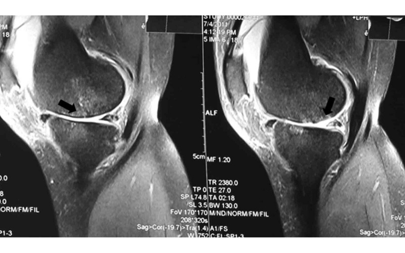 hình ảnh MRI khớp gối
