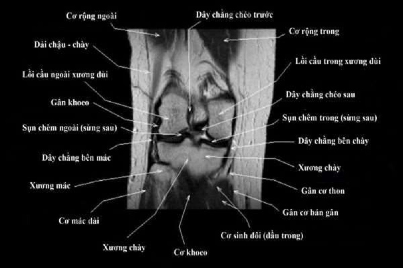 chụp mri cho khớp gối