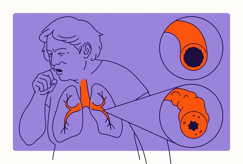 điều trị copd