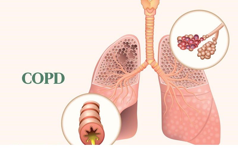 Bệnh phổi tắc nghẽn mạn tính (COPD) là một bệnh lý viêm mạn tính của đường hô hấp