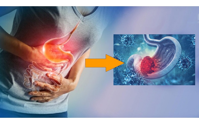 Tùy thuộc vào mức độ tổn thương và giai đoạn của bệnh ung thư dạ dày, bác sĩ sẽ đưa ra phương pháp điều trị thích hợp nhất vối người bệnh 
