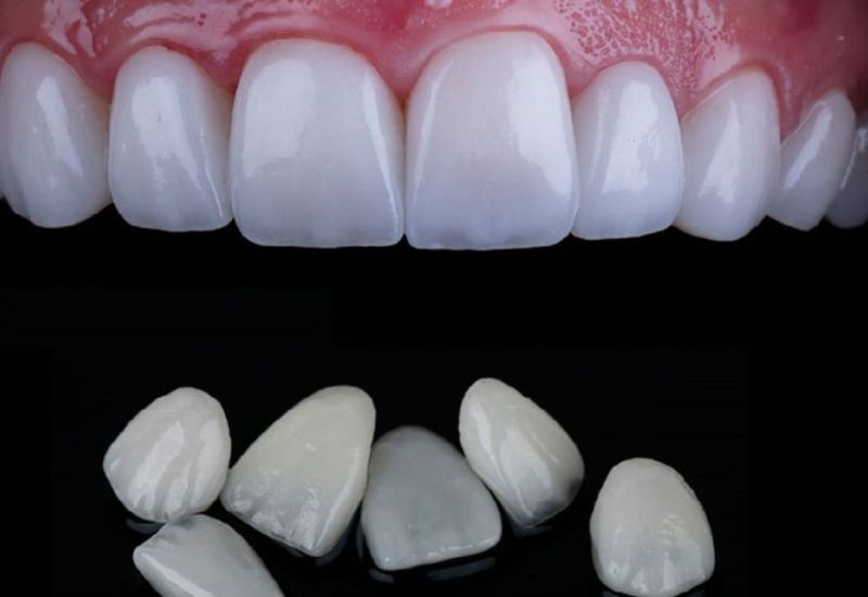 Dán sứ veneer hiện là phương pháp thẩm mỹ được ưa chuộng rộng rãi.