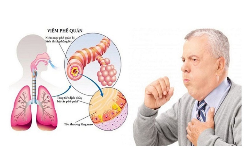 Dấu hiệu hen phế quản 